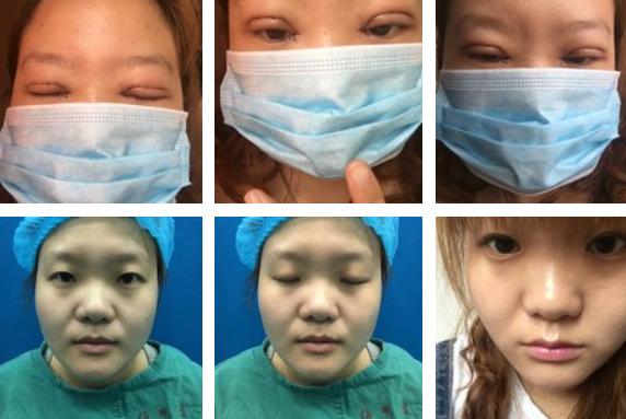 割双眼皮的危害和后遗症,拆双眼皮线痛吗