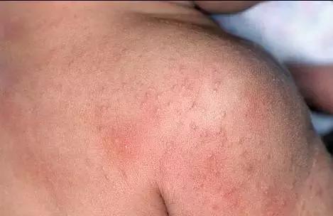 湿疹感染了严重怎么办,湿疹感染的最佳治疗方法婴儿