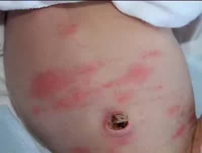 湿疹感染了严重怎么办,湿疹感染的最佳治疗方法婴儿