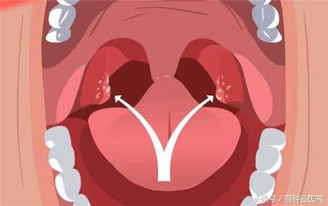 扁桃体发炎反复发烧39度多怎么办,10岁儿童扁桃体反复发炎吃什么药