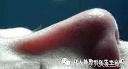 假体隆鼻透光怎么消除,假体隆鼻硅胶有可能立着吗