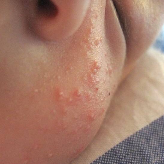 婴儿为什么会长湿疹,婴儿湿疹最怕三种菜