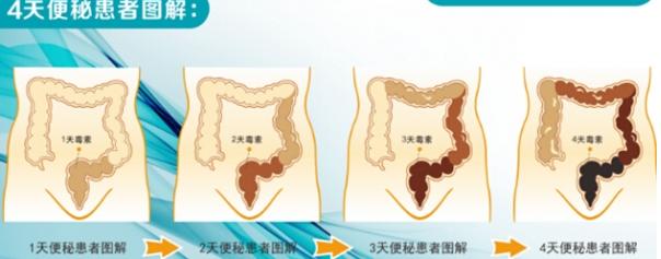 老人发生便秘首选什么办法通便,老人便秘严重临时解决办法