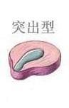 治疗腰椎间盘突出膏药排名,腰椎间盘突出最好方子