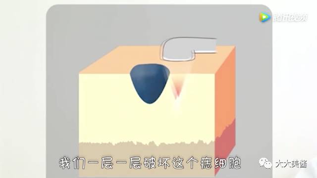 小激光点痣,激光点痣全过程视频