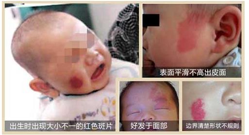 鲜红斑痣加重的三个时期,头上鲜红斑痣得sw综合征的几率