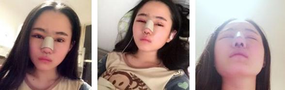 鼻综合7天山根很肿,做完膨体鼻综合修复脸特别肿