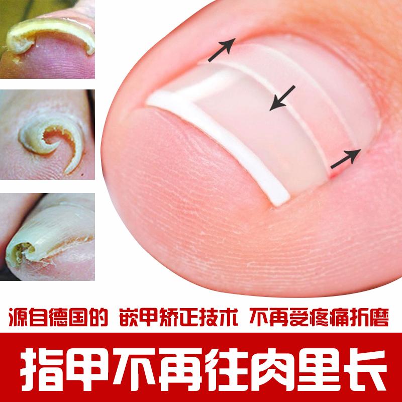 嵌甲性甲沟炎自己最佳治疗方法,嵌甲甲沟炎根治教程