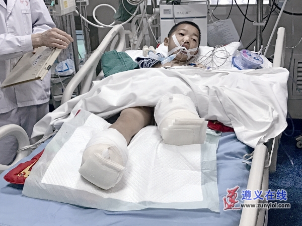 男孩被车碾压后截肢,小孩放学惨遭车撞双腿截肢