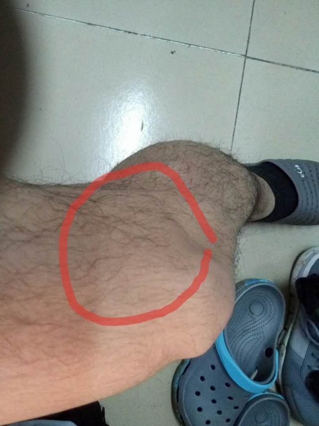 膝盖外侧上方酸胀疼痛,膝盖疼在线问答