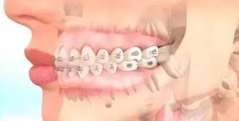 如何一秒钟矫正牙齿,牙齿矫正让你悄然改变从现在开始
