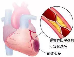 心梗疼痛打止疼针有用吗,心梗中医扎针治疗方法