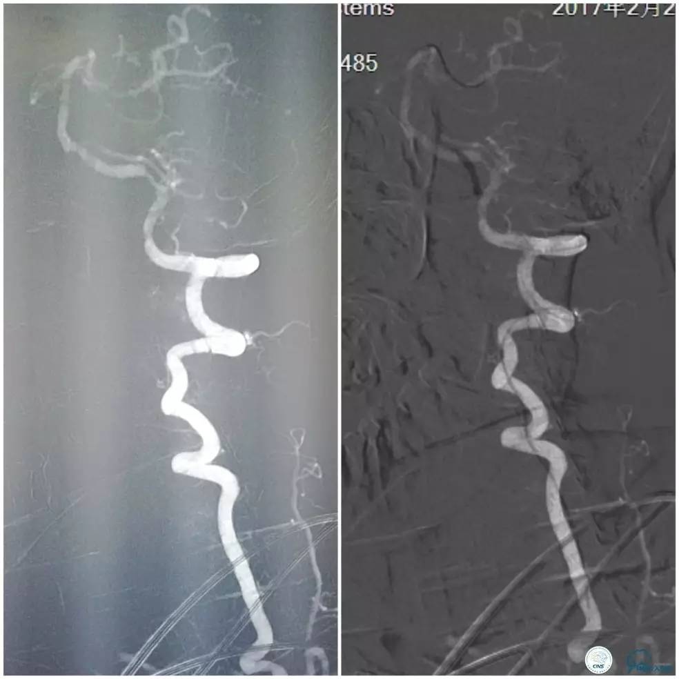 天坛椎动脉狭窄,天坛周记