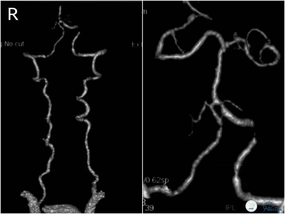 天坛椎动脉狭窄,天坛周记