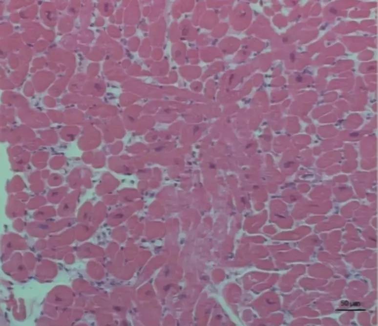 心脏增大引发的心衰能治好吗,急性心衰引起心脏扩大能治愈吗