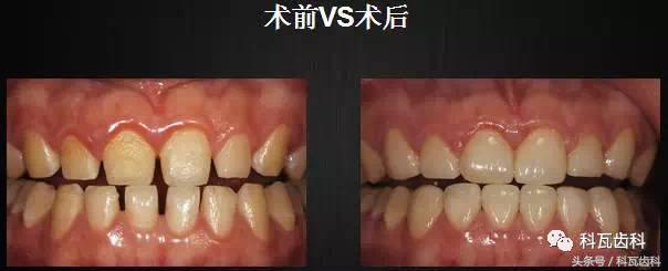 门牙旁边有缝最好的解决方法,门牙缝漏怎么补救