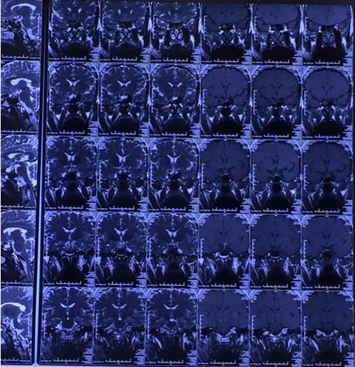 生长激素性垂体腺瘤诊断标准,垂体生长激素瘤首选的治疗方法为