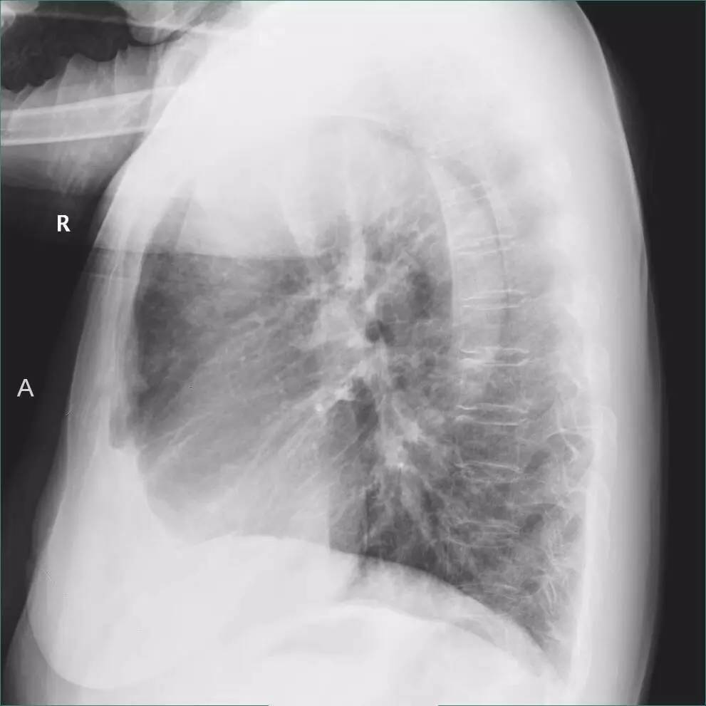 胸片怎么看胸膜粘连还是胸腔积液,胸片上怎么看局部胸膜增厚