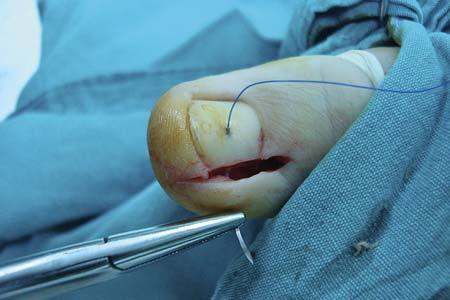 嵌甲性甲沟炎自己最佳治疗方法,嵌甲甲沟炎根治教程