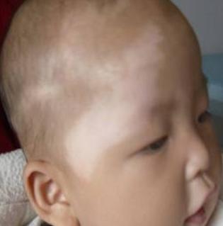 小孩子长了白斑怎么才能治好,声带白斑要关注哪些饮食