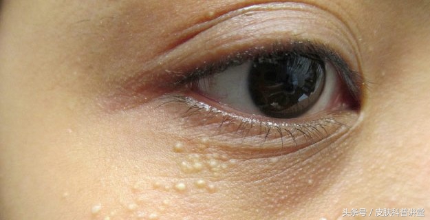 眼周很多小颗粒怎么办,眼周起斑点是什么原因