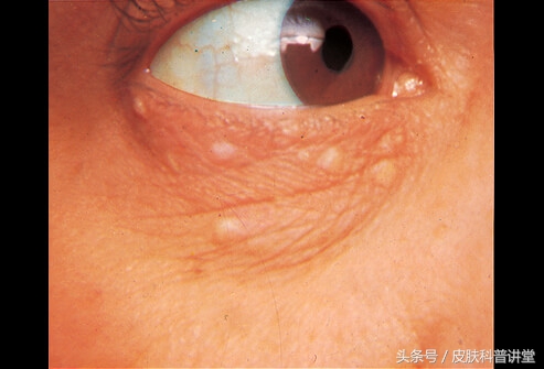 眼周很多小颗粒怎么办,眼周起斑点是什么原因