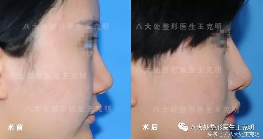 假体隆鼻透光怎么消除,假体隆鼻硅胶有可能立着吗