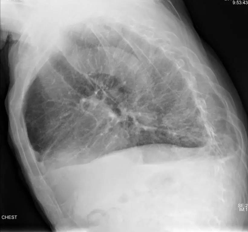 胸片怎么看胸膜粘连还是胸腔积液,胸片上怎么看局部胸膜增厚