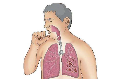 支原体感染咳嗽的症状怎么治疗,咳嗽了怎么办最有效的方法