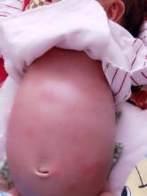 胎儿肠管扩张最坏结果,胎儿结肠肠管扩张不做羊穿