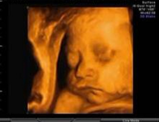 b超查出来宝宝兔唇怎么办,b超照出胎儿有兔唇