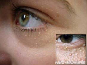 眼周很多小颗粒怎么办,眼周起斑点是什么原因