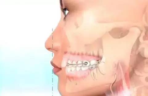 如何一秒钟矫正牙齿,牙齿矫正让你悄然改变从现在开始