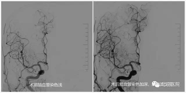 颈动脉狭窄支架手术是微创手术吗,颈动脉狭窄支架手术效果