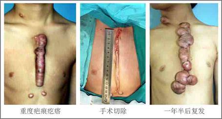 word妈呀！你真的不重视疤痕疙瘩治疗吗？看看这些危害吧