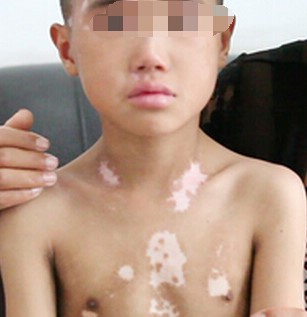 小孩子长了白斑怎么才能治好,声带白斑要关注哪些饮食
