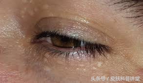 眼周很多小颗粒怎么办,眼周起斑点是什么原因