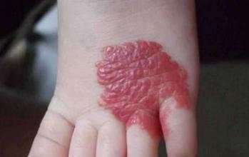 颈椎血管瘤破裂症状,腿血管瘤破裂严重么