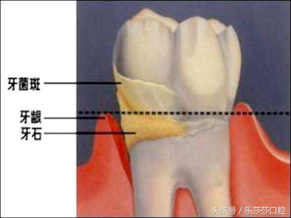 牙齿掉出一小块石头,牙齿内侧掉出一块石头怎么回事