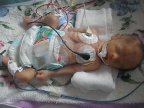 胎儿肠管扩张最坏结果,胎儿结肠肠管扩张不做羊穿