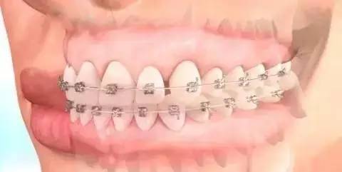 如何一秒钟矫正牙齿,牙齿矫正让你悄然改变从现在开始