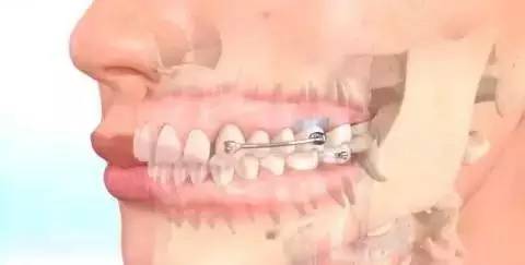 如何一秒钟矫正牙齿,牙齿矫正让你悄然改变从现在开始