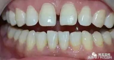 门牙旁边有缝最好的解决方法,门牙缝漏怎么补救