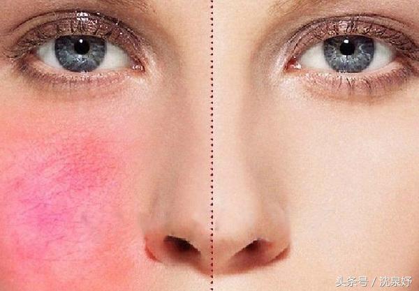 毛孔粗大还有救吗到底要如何解决,毛孔粗大有什么小方法可以解决