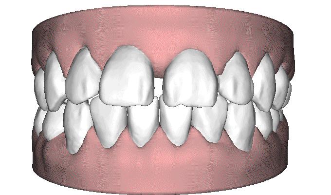 门牙旁边有缝最好的解决方法,门牙缝漏怎么补救