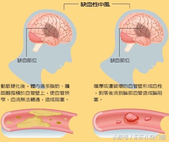 三七对脑梗塞功效与作用,脑梗塞吃药可以吃三七吗