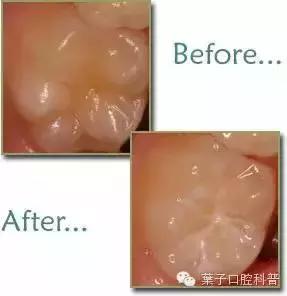 恒牙换牙不,恒牙不长出