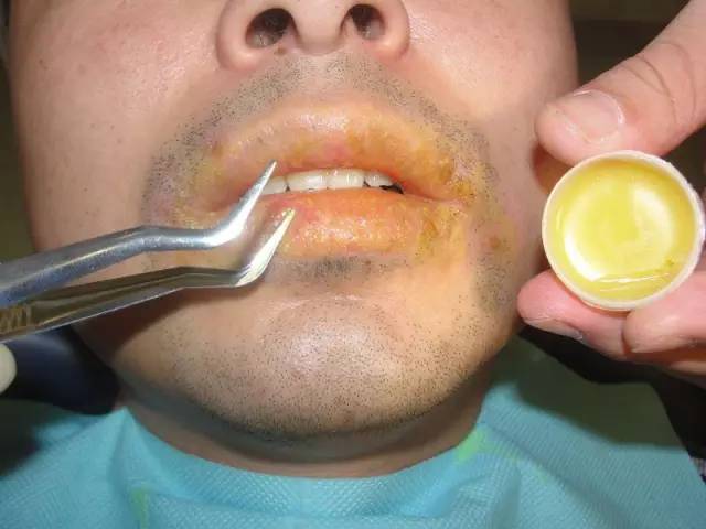 嘴唇上火起皮最快最有效的方法,上火引起的嘴唇干裂起皮怎么治