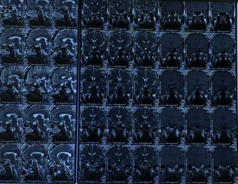 生长激素性垂体腺瘤诊断标准,垂体生长激素瘤首选的治疗方法为