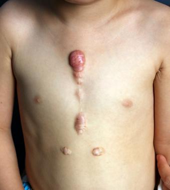 word妈呀！你真的不重视疤痕疙瘩治疗吗？看看这些危害吧